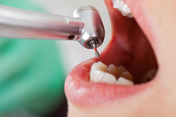 Best Emergency Treatment for Dental Infections or Abscesses in Bridgetown, MS